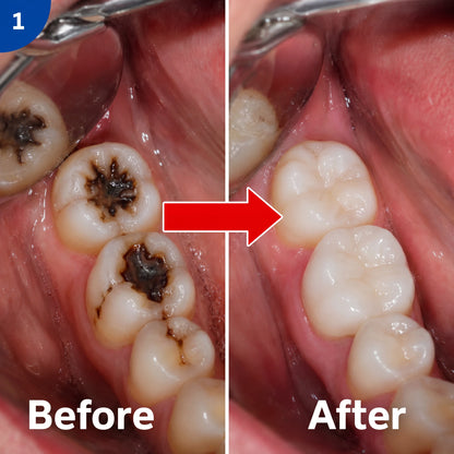 Virelia™ – Dentite Tooth Armor